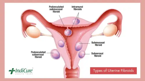 Types of Uterine Fibroids Types of Uterine Fibroids